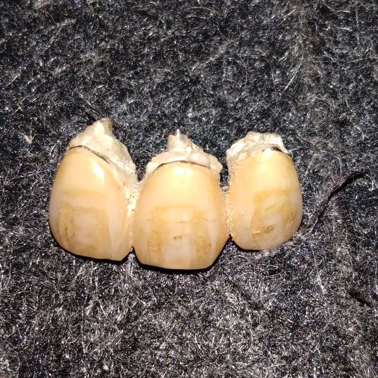 金歯（金・貴金属）の商品画像 - 査定依頼日：2023年8月5日 - 最高査定価格：50,000円